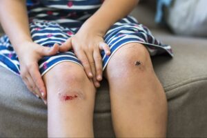 a little girl showing skinned knees from an injury at a daycare