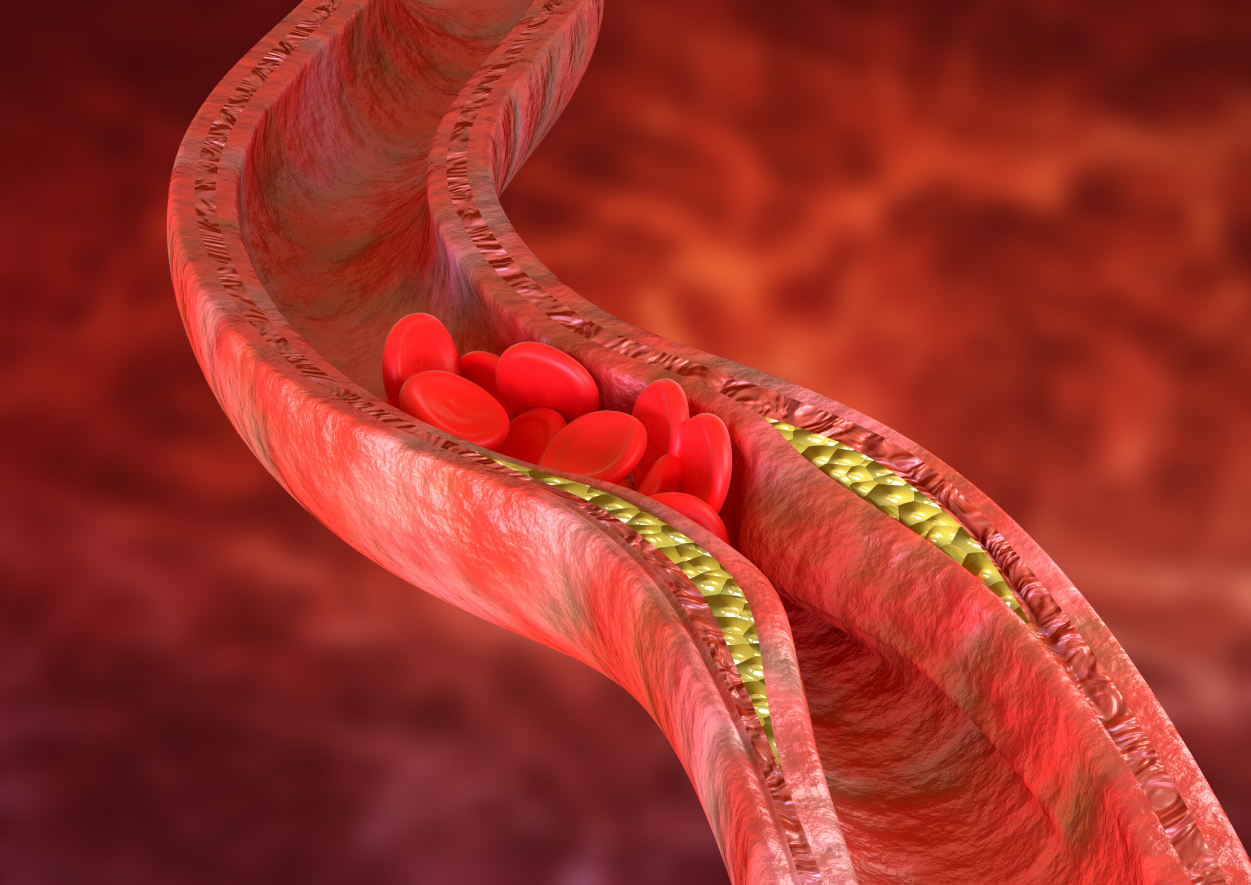 Atherosclerosis is an accumulation of cholesterol plaques in the walls of the arteries, which causes obstruction of blood flow.