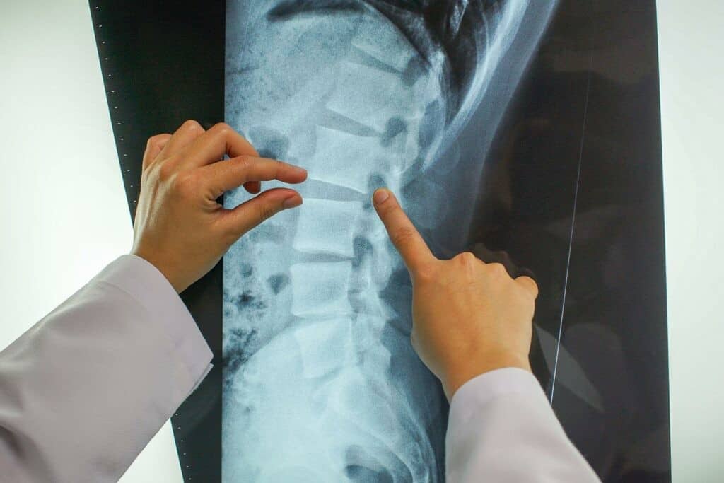 Hands pointing at an X-ray image of a spine, highlighting vertebrae. The person is wearing a white coat, indicating a medical context.