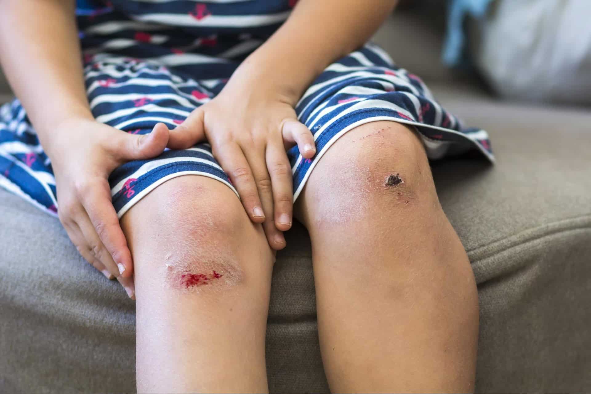 A person wearing a striped dress sits on a sofa with scraped knees showing signs of fresh and healing wounds.
