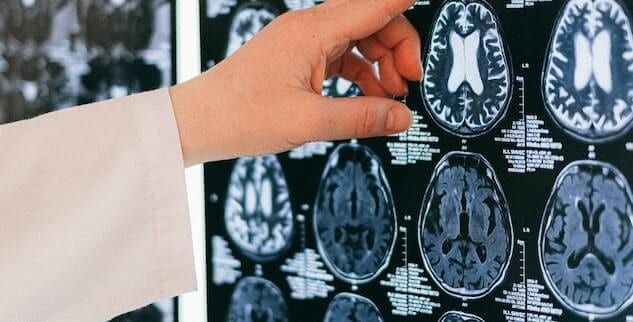 A hand points to brain scan images on a screen, showing various cross-sectional views of the brain.