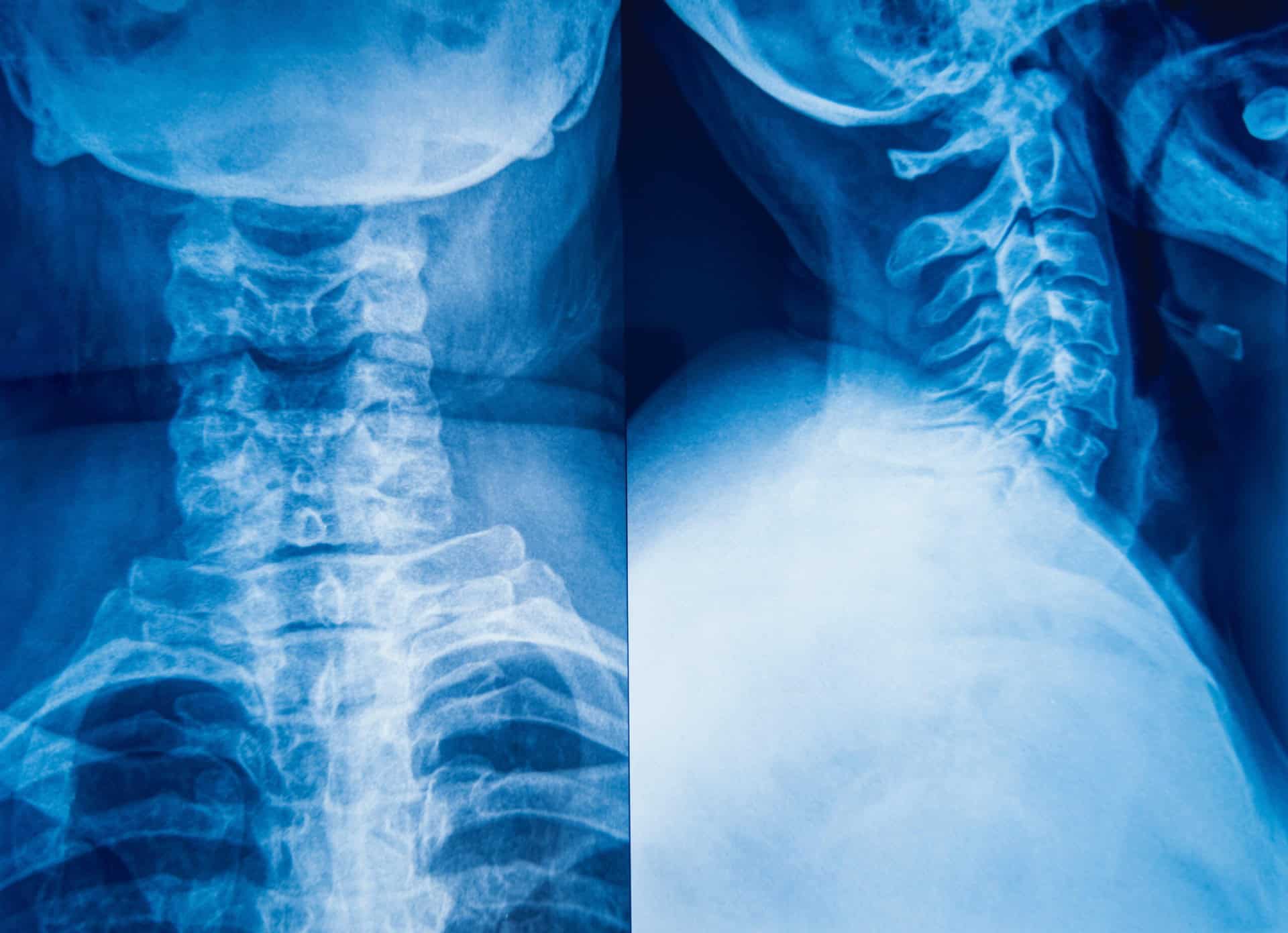 X-ray images showing a front and side view of the cervical spine in the neck region.