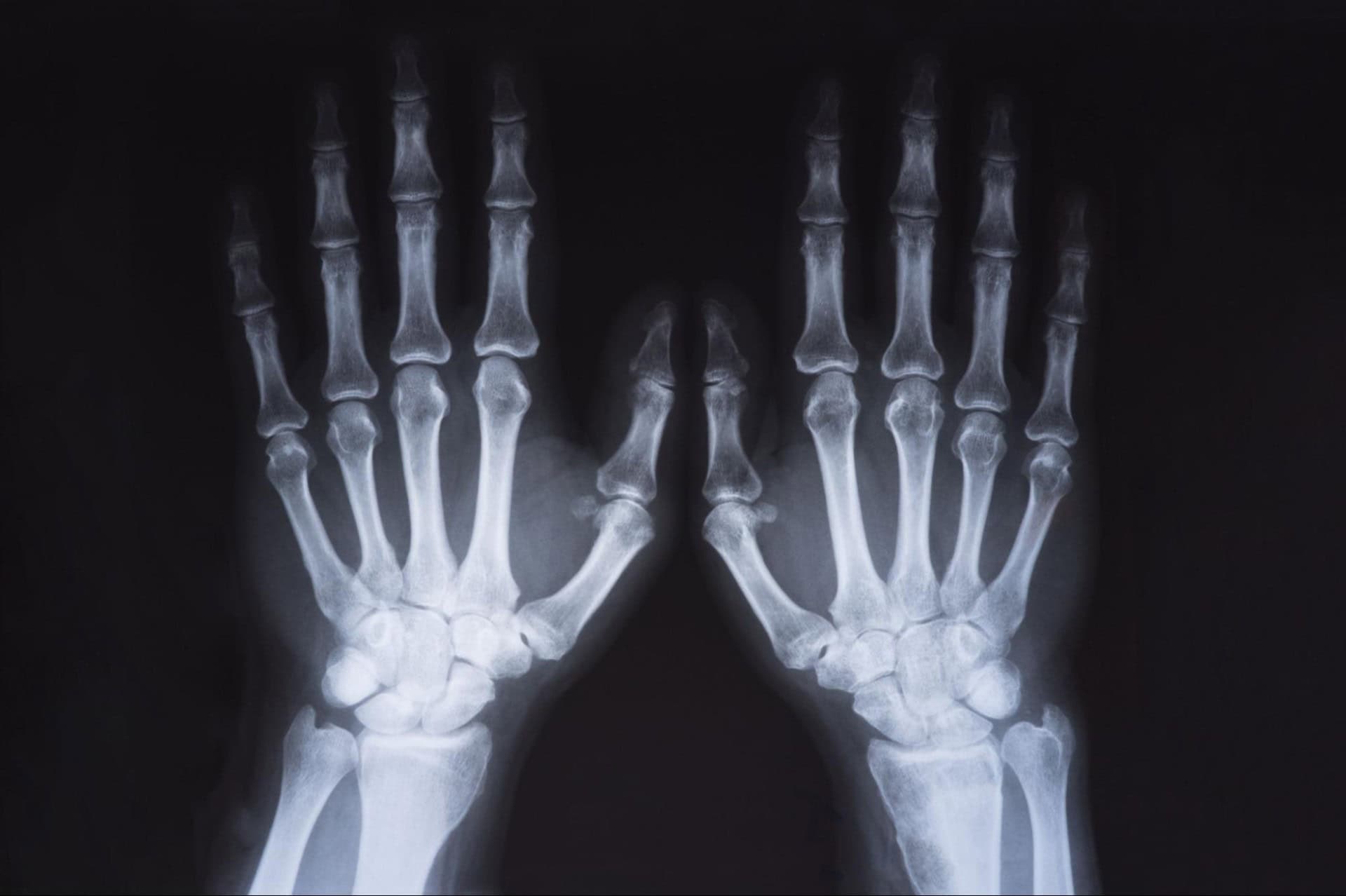 X-ray image of two hands placed side by side, showing the bones clearly against a dark background.
